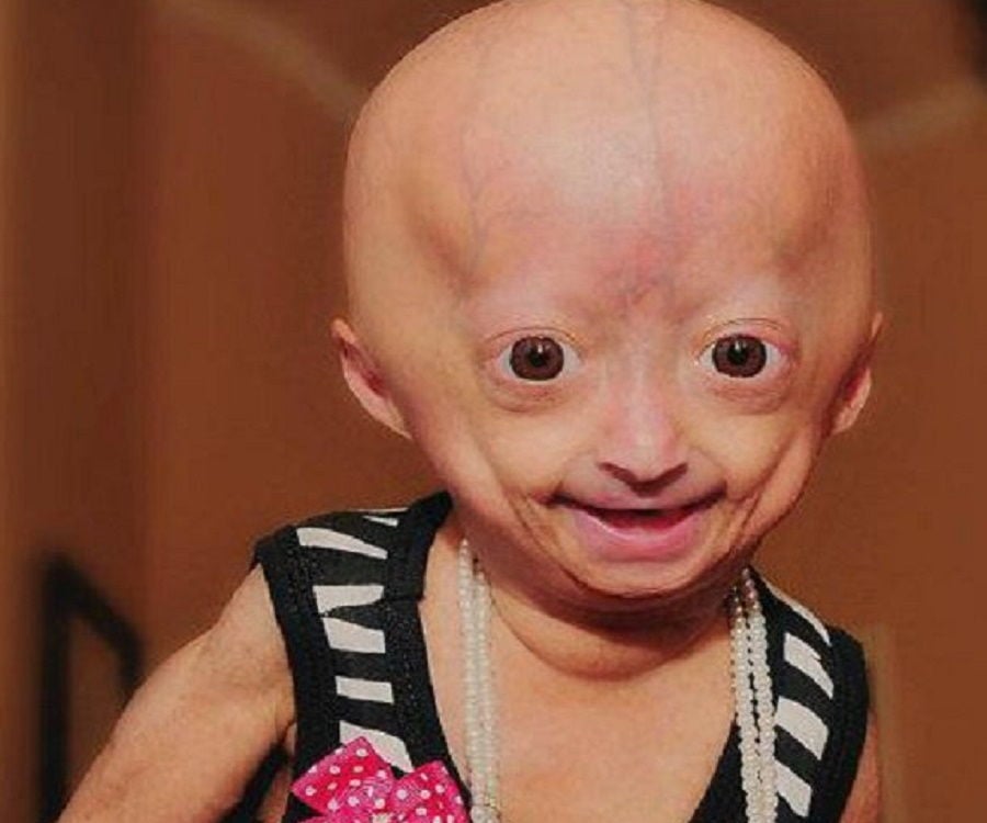 Adalia Rose - The Girl with Progeria - Facts & Her Family Life
