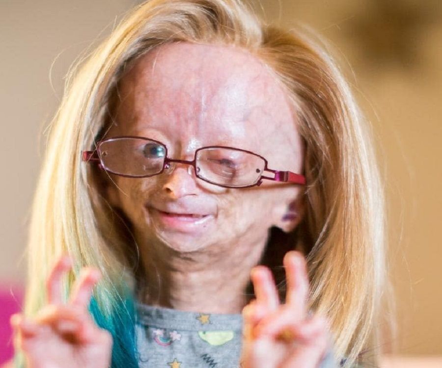 Adalia Rose - The Girl with Progeria - Facts & Her Family Life
