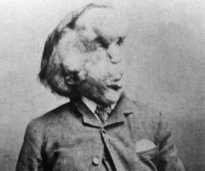 Joseph Merrick Biography